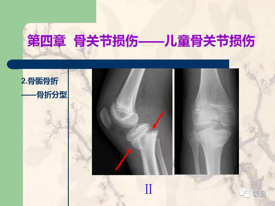 骨关节创伤x线诊断图谱,骨关节损伤x线图