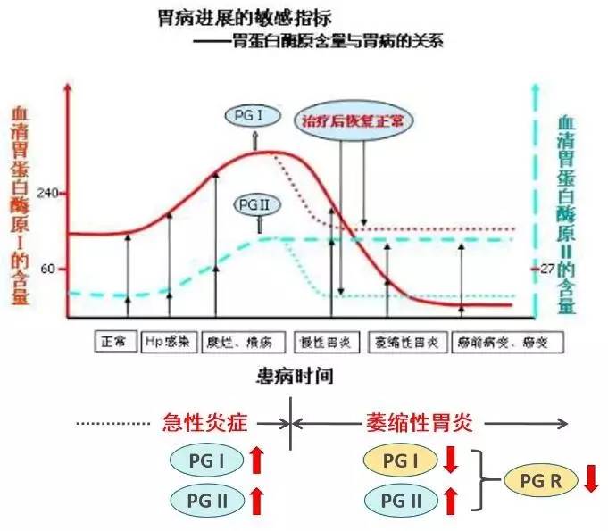 体检的胃功能三项能查出胃癌吗,胃功能三项怎么算胃癌早期