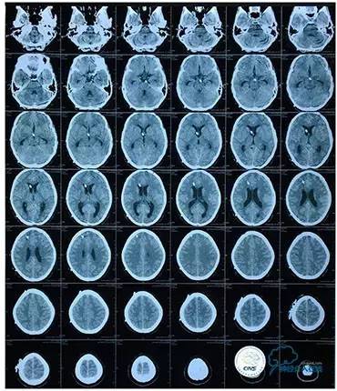 静脉窦狭窄支架植入术,静脉窦狭窄做支架多少钱