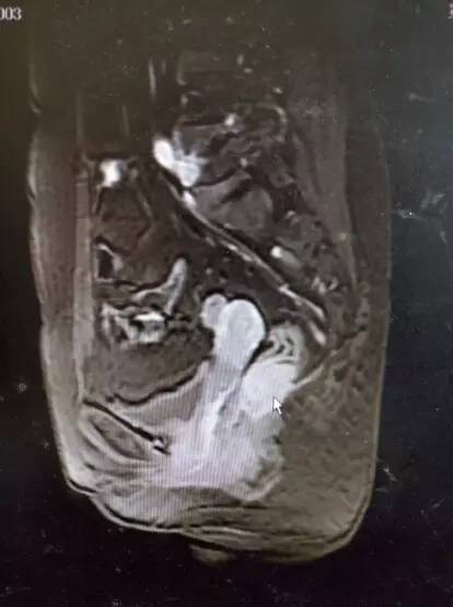 直肠神经内分泌肿瘤良性转移快吗,直肠神经内分泌瘤肝转移的后果