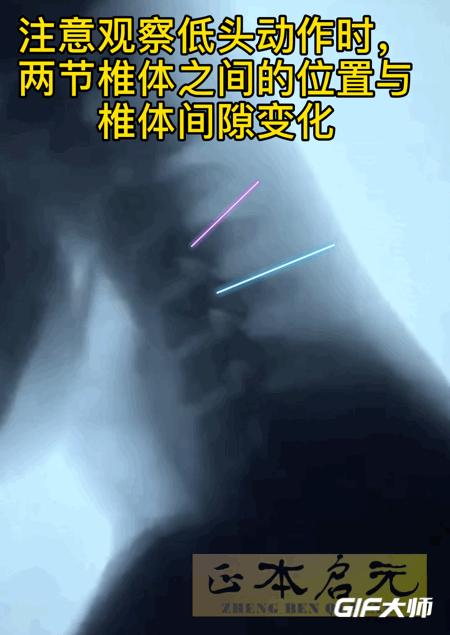 偏头颈椎就痛,颈椎病偏头是什么原因