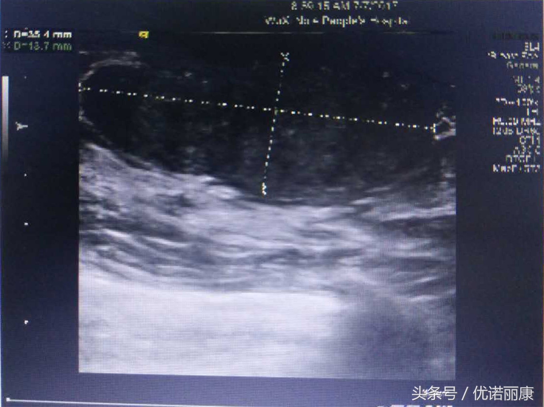 乳腺核磁共振报告专家解读,乳腺病检报告单怎么看