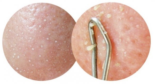 怎样去脸上粉刺和黑头粉刺,是什么原因导致脸上长粉刺