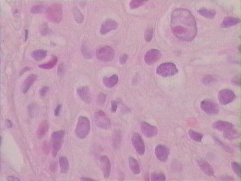 吸烟导致肺纹理增多咋办,抽烟肺纹理增粗是什么意思