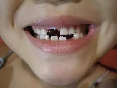 牙齿轻微缺损需要处理吗,牙齿楔状缺损修补多少钱