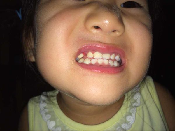 地包天是啥意思有什么不好吗,地包天到底是什么