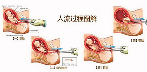 低价人流,低价手术有哪些猫腻