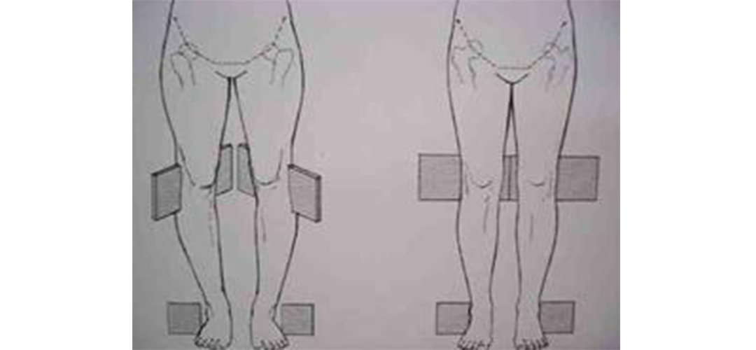 跷二郎腿的腿变形了还有救吗,13岁二郎腿翘多了变形怎么改正