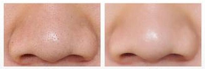 圆头粉刺针清除鼻子上的黑头粉刺,鼻子有螨虫黑头怎么彻底清除