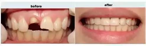 牙齿轻微缺损需要处理吗,牙齿楔状缺损修补多少钱