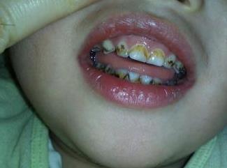 地包天是啥意思有什么不好吗,地包天到底是什么