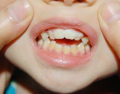 地包天是啥意思有什么不好吗,地包天到底是什么