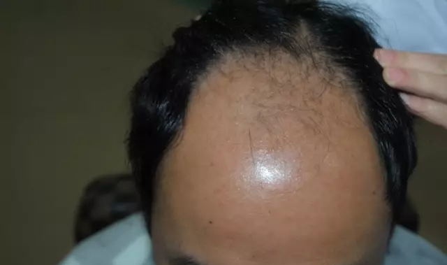 毛囊检测可以查出脱发原因吗,毛囊检测都是正常脱发还有救吗