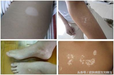 白癜风自体表皮移植多久恢复,白癜风自体移植用的哪个部位的皮