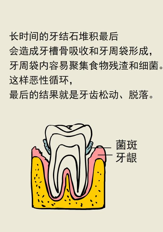 为什么洗牙以后还要做牙周刮治,为什么洗牙后还要刮治