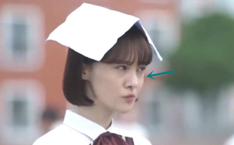 郑爽泪沟、眼袋明显到糊住镜头，学生*党**们的通病该怎么治？