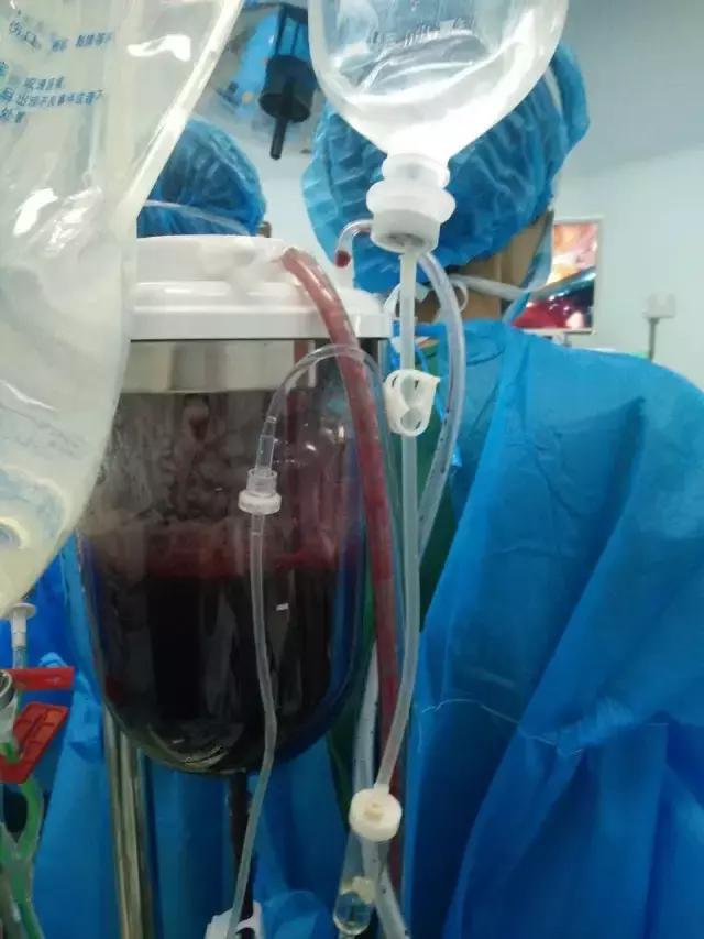 自体血回输1500毫升需要多长时间,自体血回输失血估算