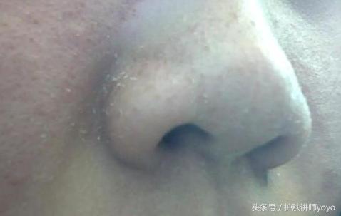 皮肤的皮脂膜受损怎么修复,皮脂膜受损皮肤干