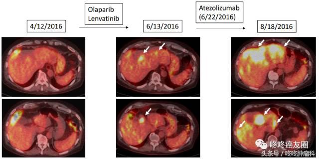 pd-1适用于每个人吗,如何知道pd-1是否适合