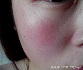 皮肤的皮脂膜受损怎么修复,皮脂膜受损皮肤干