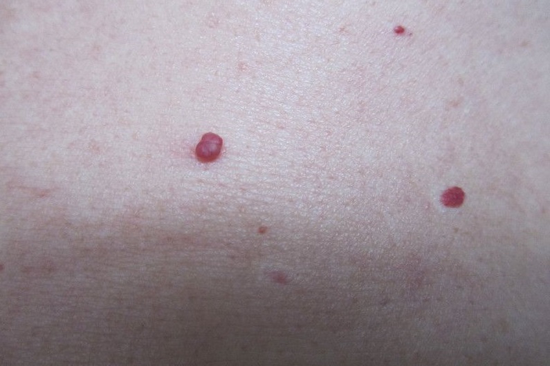 全身突然出现很多小红痣不痛不痒,身上突然长很多小红痣是什么原因