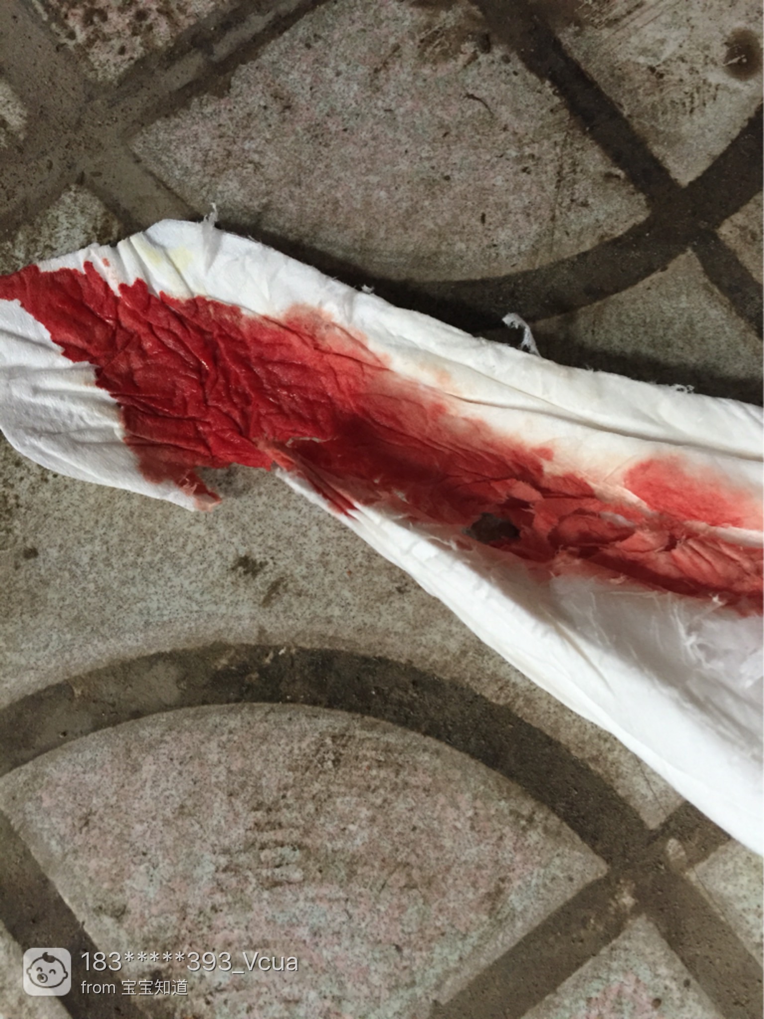 辟谣：孕妇见红就要生？全面解说“见红”和“出血”的区别！