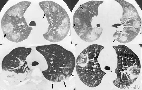 有一种真菌,专门在肺部原有疾病产生的空洞里长小球,消不掉,咳不出,有时候会引起致命大出血