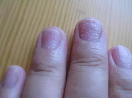 指甲整个掉了需要注意哪些,小孩的指甲应该怎么处理