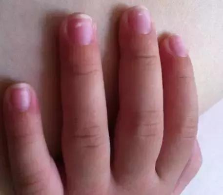 指甲整个掉了需要注意哪些,小孩的指甲应该怎么处理