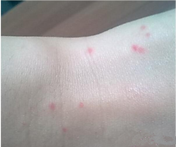 全身突然出现很多小红痣不痛不痒,身上突然长很多小红痣是什么原因