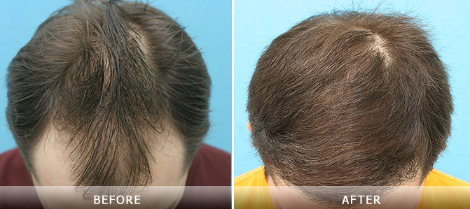 毛囊检测可以查出脱发原因吗,毛囊检测都是正常脱发还有救吗