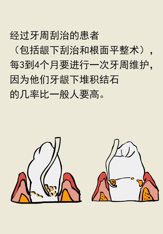 为什么洗牙以后还要做牙周刮治,为什么洗牙后还要刮治