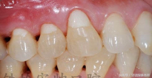 美学补牙和普通补牙区别,除了树脂补牙还有什么材料补牙