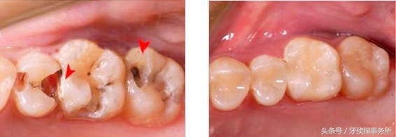 美学补牙和普通补牙区别,除了树脂补牙还有什么材料补牙