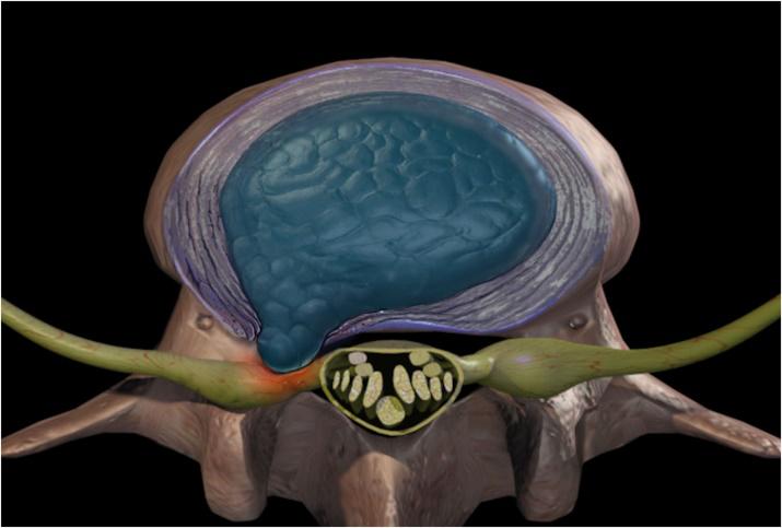 腰椎间盘突出能够压迫胳膊神经吗,腰椎间盘突出能够完全康复吗