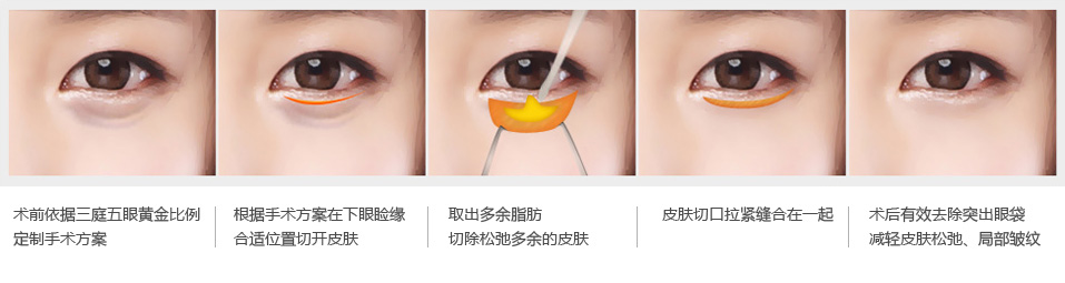 郑爽泪沟、眼袋明显到糊住镜头，学生*党**们的通病该怎么治？