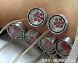 白癜风自体表皮移植多久恢复,白癜风自体移植用的哪个部位的皮