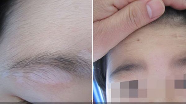 美国研发白癜风特效药,美国白癜风特效药进口