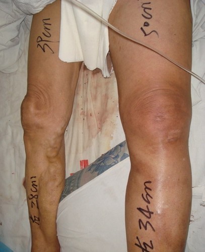 静脉血栓栓塞预防和治疗专家共识,静脉血栓防治的题目