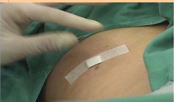 腰椎间盘突出能够压迫胳膊神经吗,腰椎间盘突出能够完全康复吗