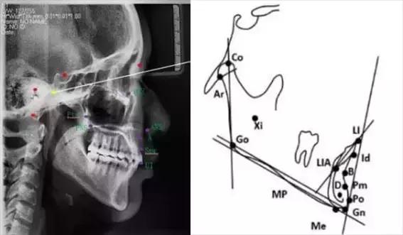 正畸头影测量中的y轴怎么测,正畸投影测量基础讲解