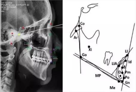 正畸头影测量中的y轴怎么测,正畸投影测量基础讲解