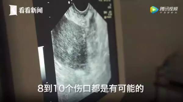 捐卵,被明码标价的青春|关于捐卵应该知道的科普