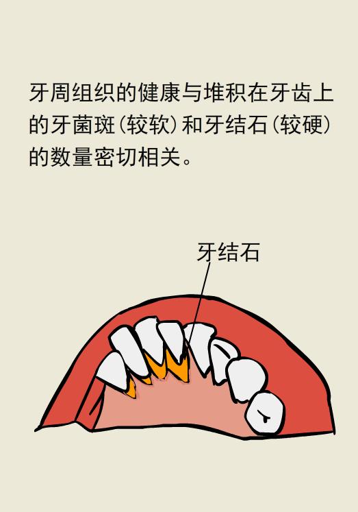 为什么洗牙以后还要做牙周刮治,为什么洗牙后还要刮治
