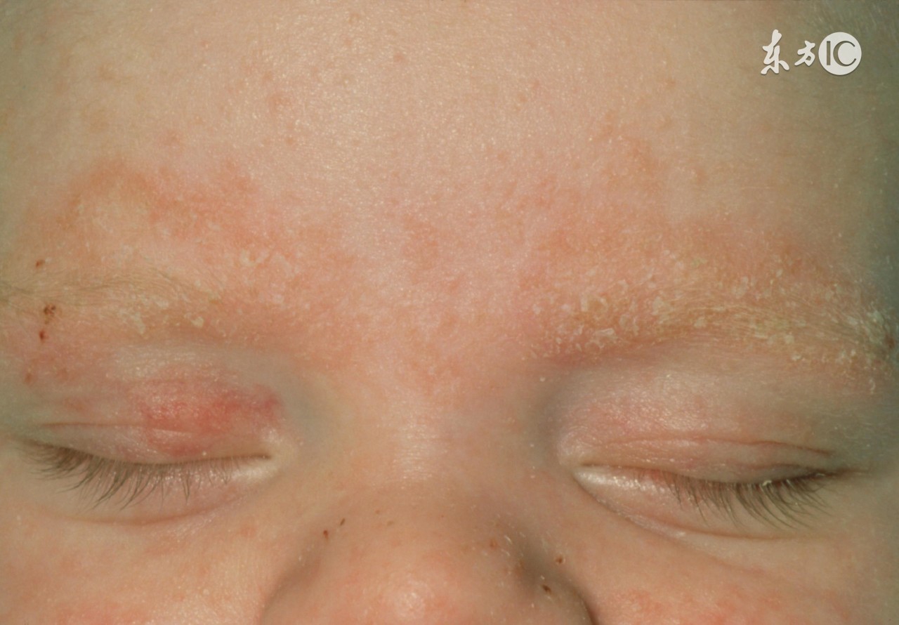 孩子夏天起一身疹子怎么办,宝宝身上起的像痱子一样的小痘痘