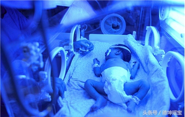 15天黄疸240严不严重病理性黄疸,新生儿病理性黄疸17.5需要住院吗