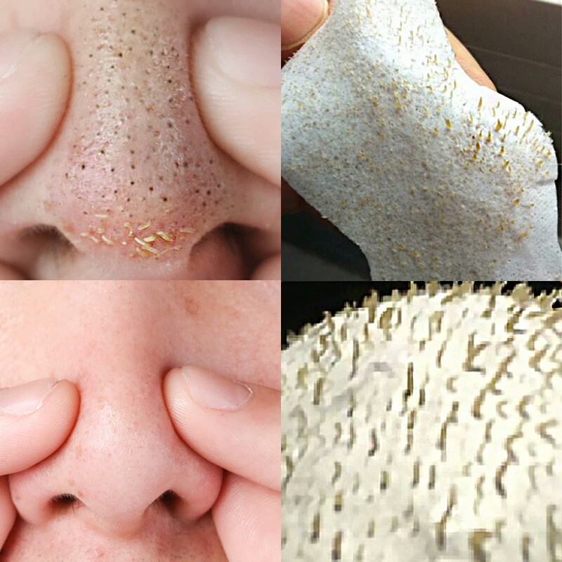 教你去黑头小妙招方法简单效果好,怎么用黑头针去除黑头