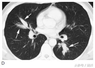 有一种真菌,专门在肺部原有疾病产生的空洞里长小球,消不掉,咳不出,有时候会引起致命大出血