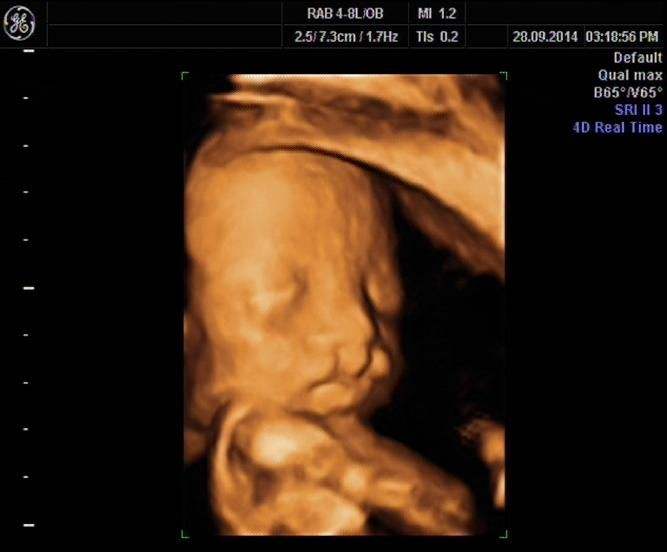 怀孕后查出胎儿兔唇咋办,怀孕后期超声还会看清胎儿兔唇吗