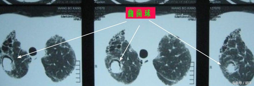 有一种真菌,专门在肺部原有疾病产生的空洞里长小球,消不掉,咳不出,有时候会引起致命大出血